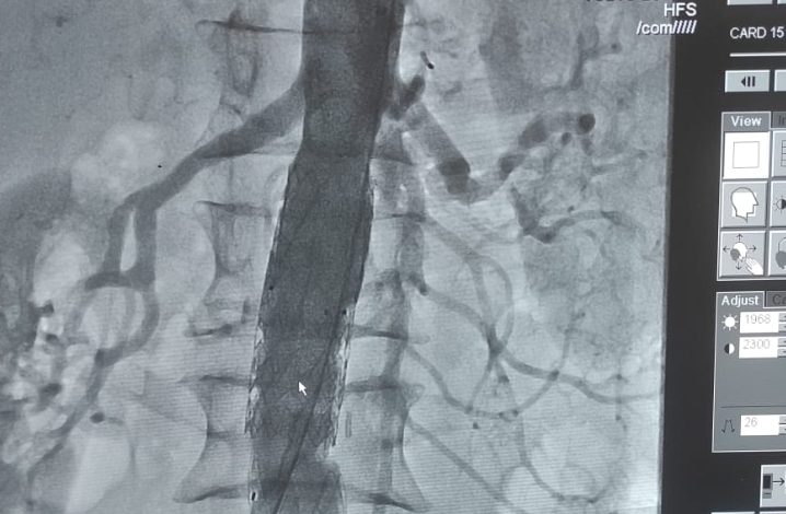 खास खबर ::आईजीएमसी  में  कटऑफ रूट के हिसाब से ग्राफ्ट स्टेंट डालने का पहला मामला