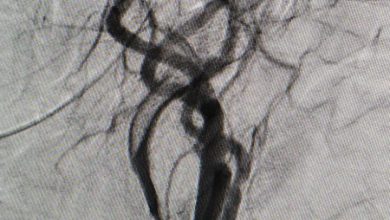 खास खबर : मरीज ने खोई बोलने की क्षमता, इस तरह आईजीएमसी के डॉक्टर और डीएसए मशीन ने   बचाई मरीज की जान