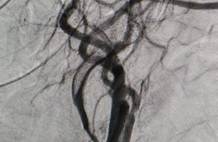 खास खबर : मरीज ने खोई बोलने की क्षमता, इस तरह आईजीएमसी के डॉक्टर और डीएसए मशीन ने बचाई मरीज की जान खास खबर : मरीज ने खोई बोलने की क्षमता, इस तरह आईजीएमसी के डॉक्टर और डीएसए मशीन ने बचाई मरीज की जान