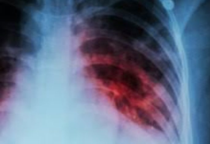 खास खबर : अब घर द्वार जाकर टीबी रोगियों की जांच में लाई जाएगी तेज़ी खास खबर : अब घर द्वार जाकर टीबी रोगियों की जांच में लाई जाएगी तेज़ी