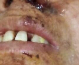 बड़ी खबर: आईजीएमसी में आया ब्लैक फंगस का मरीज