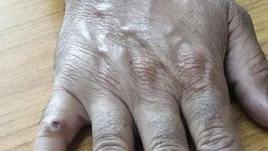 EXCLUSIVE: गुलाब पहुंचा रहा आईजीएमसी, जाने कैसे?