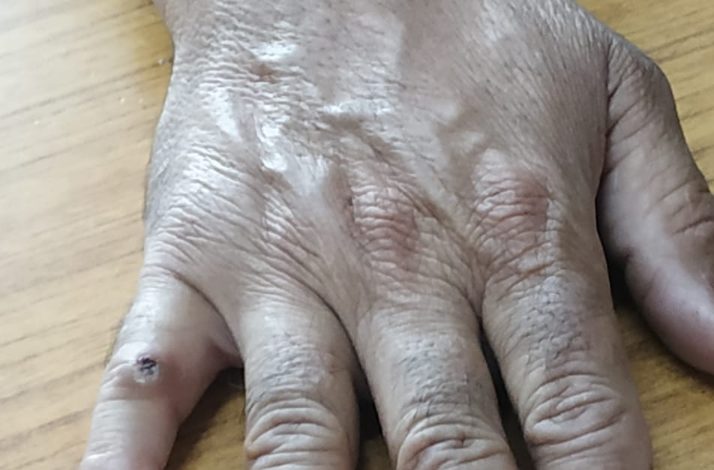 EXCLUSIVE: गुलाब पहुंचा रहा आईजीएमसी, जाने कैसे?