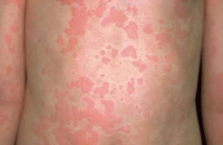 असर विशेष : अलर्ट: आर्टिकेरिया में लापरवाही नहीं असर विशेष : अलर्ट: आर्टिकेरिया में लापरवाही नहीं