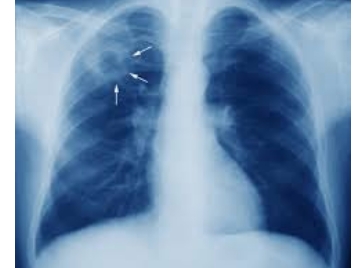 टीबी उन्मूलन पर केंद्रीय टीम पहुंची हिमाचल टीबी उन्मूलन पर केंद्रीय टीम पहुंची हिमाचल