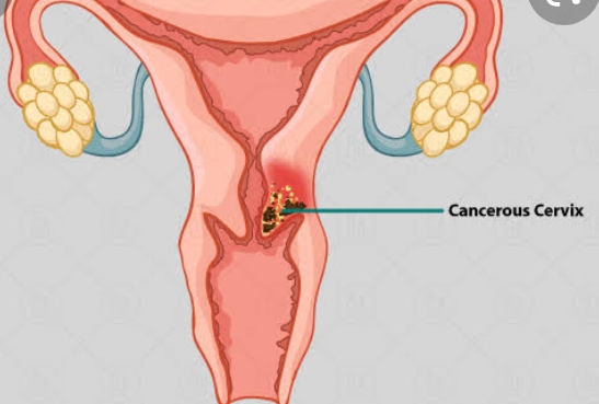 असर विशेष: सर्वाइकल कैंसर का जाल फैला हिमाचल में, पर हिमाचल में जागरूकता ज़ीरो असर विशेष: सर्वाइकल कैंसर का जाल फैला हिमाचल में, पर हिमाचल में जागरूकता ज़ीरो