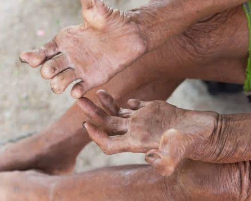 खास खबर: हिमाचल में हर वर्ष कुष्ठ रोग के सौ नए मामले खास खबर: हिमाचल में हर वर्ष कुष्ठ रोग के सौ नए मामले