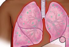 असर विशेष : टीबी मुक्त भारत अभियान में हिमाचल अव्वल असर विशेष : टीबी मुक्त भारत अभियान में हिमाचल अव्वल