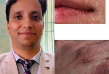 ठंड में खतरे की घंटी: सूखी हवा ने बढ़ाई त्वचा रोगों की समस्या ठंड में खतरे की घंटी: सूखी हवा ने बढ़ाई त्वचा रोगों की समस्या