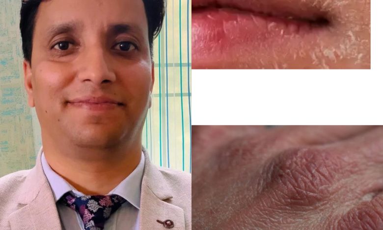 ठंड में खतरे की घंटी: सूखी हवा ने बढ़ाई त्वचा रोगों की समस्या ठंड में खतरे की घंटी: सूखी हवा ने बढ़ाई त्वचा रोगों की समस्या